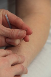 what is acupuncture, Colorado Springs acupuncturist